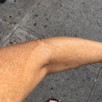 Future Tan Midtown - My arm with spray markings after two hours. - Teeth Whitening Near Me - New York, New York