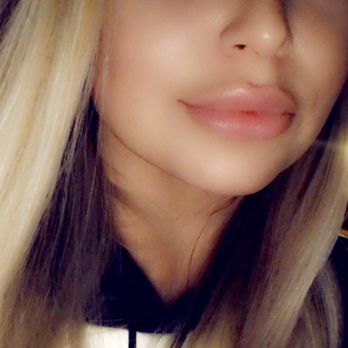 Lake Oswego Aesthetics - 2 weeks after juvederm lip filler - Medical Spas Near Me - Lake Oswego, Oregon Lake Oswego Aesthetics - 2 weeks after juvederm lip filler - Medical Spas Near Me - Lake Oswego, Oregon