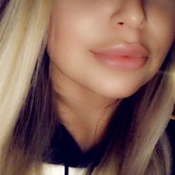 Lake Oswego Aesthetics - 2 weeks after juvederm lip filler