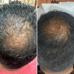 AcuBethel Acupuncture & Herbs - #Hair_loss_treatment #OC_acupuncture #herbs #Cupping #Stress_relief #anxiety