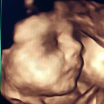 Peek-A-Bump Ultrasound - Ultrasound Imaging Centers Near Me - Bellingham, Washington Peek-A-Bump Ultrasound - Ultrasound Imaging Centers Near Me - Bellingham, Washington
