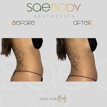 Saebody Aesthetics - Other side view - Body Contouring Near Me - Castro Valley, California