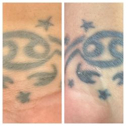 Artistry Of Permanent Makeup - Magnetic Tattoo Removal Examples