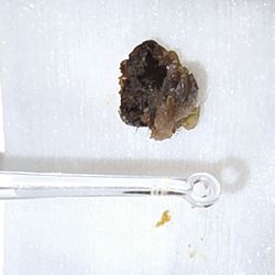 Zone1hearing - With a little help from our ENT tools we extracted this earwax blockage