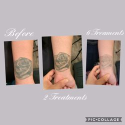 New Skin Tattoo Removal