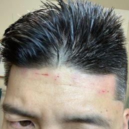 Scars on my forehead from a straight razor line up. Smh. Scars on my forehead from a straight razor line up. Smh.