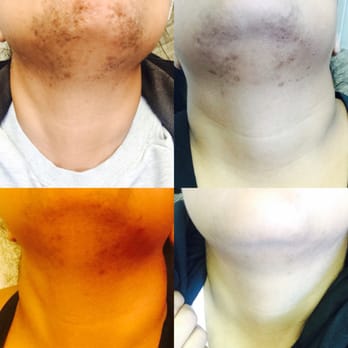Laser MD MedSpa - 6months....loving the results so far - Skin Care Near Me - Danvers, Massachusetts