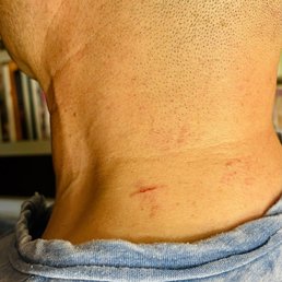 My neck after Danny the barber slashed me. You can also see major razor burn. He was extremely careless. Avoid this shop. My neck after Danny the barber slashed me. You can also see major razor burn. He was extremely careless. Avoid this shop.