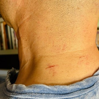 Pico Barber Shop - My neck after Danny the barber slashed me. You can also see major razor burn. He was extremely careless. Avoid this shop. - Barbers Near Me - Santa Monica, California Pico Barber Shop - My neck after Danny the barber slashed me. You can also see major razor burn. He was extremely careless. Avoid this shop. - Barbers Near Me - Santa Monica, California