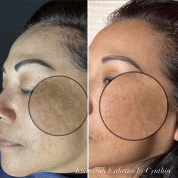 The Salon Avenue - Hyper pigmentation, chemical peel by Cynthia S. - Hair Salons Near Me - Visalia, California The Salon Avenue - Hyper pigmentation, chemical peel by Cynthia S. - Hair Salons Near Me - Visalia, California