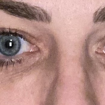 Face by Erin - You can clearly see the lumps of filler that appear to have dropped. Regardless, the bulges aren't what anyone wants to be left with. - Medical Spas Near Me - Portland, Oregon