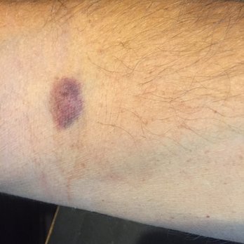 Resolution Advanced Imaging Center - How hard is it to do an IV without doing this...? - Diagnostic Imaging Near Me - Santa Monica, California Resolution Advanced Imaging Center - How hard is it to do an IV without doing this...? - Diagnostic Imaging Near Me - Santa Monica, California