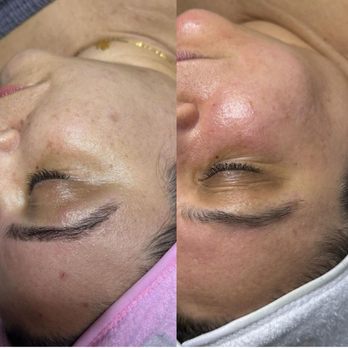 Glo By G - Treating hyperpigmentation with a monthly chemical peel - Estheticians Near Me - Tarpon Springs, Florida Glo By G - Treating hyperpigmentation with a monthly chemical peel - Estheticians Near Me - Tarpon Springs, Florida