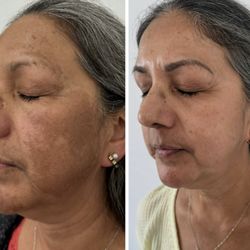 Honeys Skincare - Esthetician Sara's client. Before and progress pictures