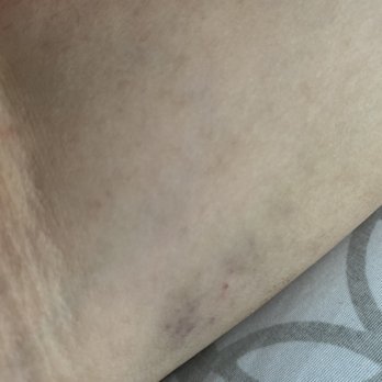 Quest Diagnostics - My bruised arm. & I don't bruise easily - Laboratory Testing Near Me - Elk Grove, California Quest Diagnostics - My bruised arm. & I don't bruise easily - Laboratory Testing Near Me - Elk Grove, California