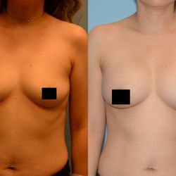 Beck Aesthetic Surgery - Dr. Joel Beck - A 34 year old woman who underwent a breast augmentation using Sientra 250 LP implants.