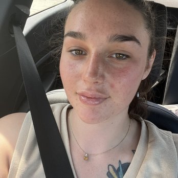 Skin Savvy - 2 days after injections - Skin Care Near Me - Hermosa Beach, California Skin Savvy - 2 days after injections - Skin Care Near Me - Hermosa Beach, California