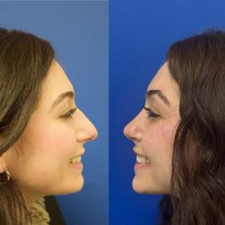 Samir S Undavia, MD - Deprojection Rhinoplasty