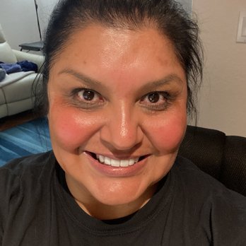 Central Coast Allure Medspa - After photo, 3hrs later The Perfect Peel - Medical Spas Near Me - Santa Maria, California