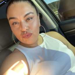Lip injections, Botox and fillers under eyes.