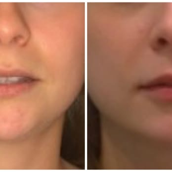 PureSkin Aesthetics - Lips - Before/After - Medical Spas Near Me - Tysons, Virginia