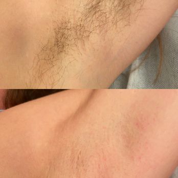 Covenly Esthetics - Underarm Sugar - Estheticians Near Me - San Jose, California Covenly Esthetics - Underarm Sugar - Estheticians Near Me - San Jose, California