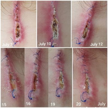 Michael P Tabibian, MD - This is the horrible healing process I endured - Dermatologists Near Me - Los Alamitos, California Michael P Tabibian, MD - This is the horrible healing process I endured - Dermatologists Near Me - Los Alamitos, California