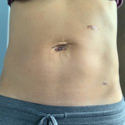 Torrance Hernia Center - Two days after Umbilical Hernia surgery. The procedure was performed laparoscopically and no stitches or staples (just glue).