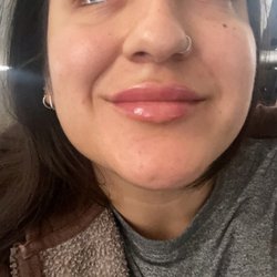 Sloan Aesthetics - I LOVE MY lips &dysport ! Injector Neicya is the sweetest and cares for her guests! I highly recommend going to Sloan Aesthetics