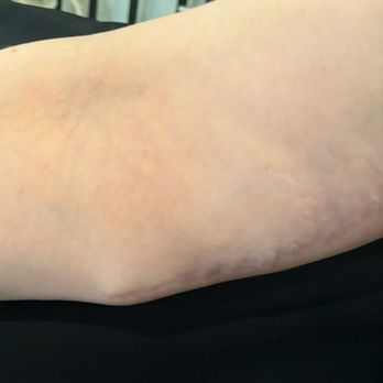 Precision Plastic Surgery - Dog ear on my right elbow - Cosmetic Surgeons Near Me - Rancho Cucamonga, California