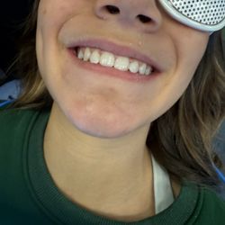 Buttram Orthodontics - Mara's braces are off!!!