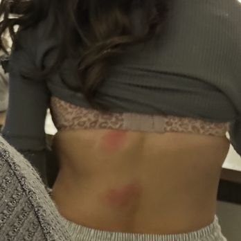 Hyatt House Denver Tech Center - New case of spider bites - Hotels Near Me - Englewood, Colorado Hyatt House Denver Tech Center - New case of spider bites - Hotels Near Me - Englewood, Colorado