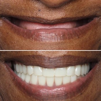 Bidwell Dental - Implant retained dentures completed by Dr. Rob - General Dentistry Near Me - Folsom, California