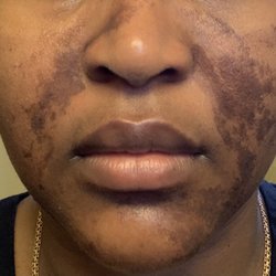 Chemical burn done by Wendy 2023