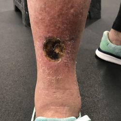 Dina Hunter, MD - radiation necrosis as finally diagnosed May 15 by Wound Center