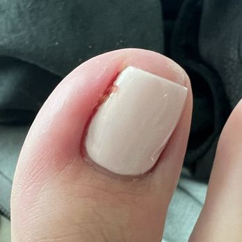 My Nail Fairy - A close up of the swelling and meaty skin hanging over my nail - Nail Salons Near Me - Glendora, California My Nail Fairy - A close up of the swelling and meaty skin hanging over my nail - Nail Salons Near Me - Glendora, California