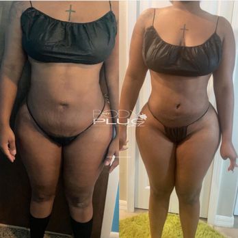My Body Plug Studio - MY BODY PLUG STUDIO BEFORE & AFTER - Body Contouring Near Me - Southfield, Michigan My Body Plug Studio - MY BODY PLUG STUDIO BEFORE & AFTER - Body Contouring Near Me - Southfield, Michigan