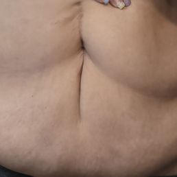 Belly scar and overhang