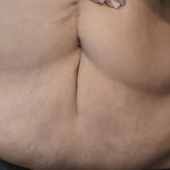 Smith Plastic Surgery - Belly scar and overhang - Cosmetic Surgeons Near Me - Las Vegas, Nevada