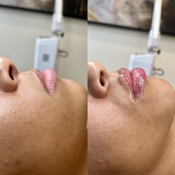 Glow Skin Med Spa - Lip filler