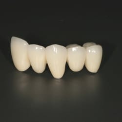 DenTech International - PFM Bridge
