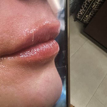 Precision Aesthetics - After - Medical Spas Near Me - Lake Elsinore, California