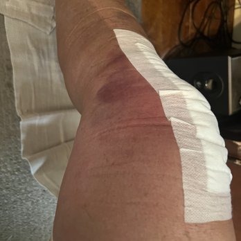 Nanoknee Institute - Post operation photo of right knee after Nano knee procedure - Surgeons Near Me - Torrance, California