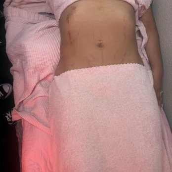 Waisted Body Bar - Post op lipo - Body Contouring Near Me - Oceanside, California Waisted Body Bar - Post op lipo - Body Contouring Near Me - Oceanside, California