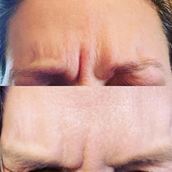 Sparkling Beauty Bar - Botox in the Glabella (the 11's)