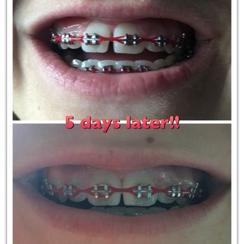 Phan Orthodontics - Phantastic results! - Orthodontists Near Me - San Jose, California