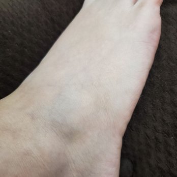Temecula Wine & Beer Garden - Bruised, swollen foot from them stepping on her feet - Bars Near Me - Temecula, California Temecula Wine & Beer Garden - Bruised, swollen foot from them stepping on her feet - Bars Near Me - Temecula, California