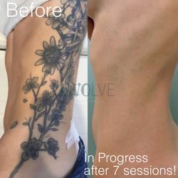 Evolve Tattoo Removal - This patient had very large tattoos that were no match for our Astanza laser.
