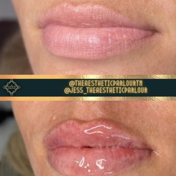 Shadow Aesthetics - LIP FILLER - Medical Spas Near Me - Franklin, Tennessee Shadow Aesthetics - LIP FILLER - Medical Spas Near Me - Franklin, Tennessee