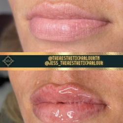Shadow Aesthetics - LIP FILLER